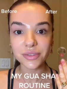 Gua Sha Before And After